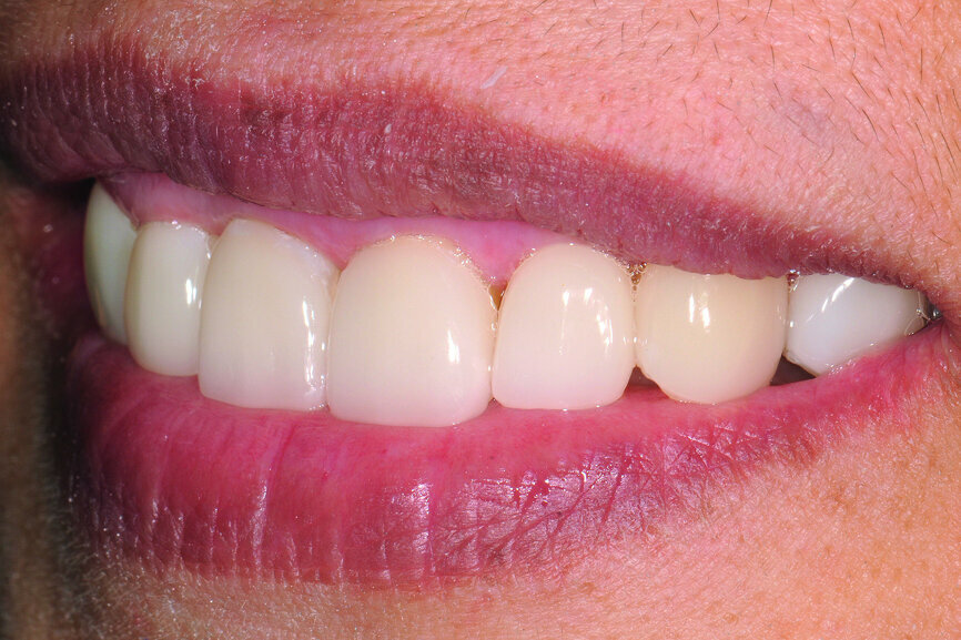 Fig. 24: Try-in: lateral view of smile.