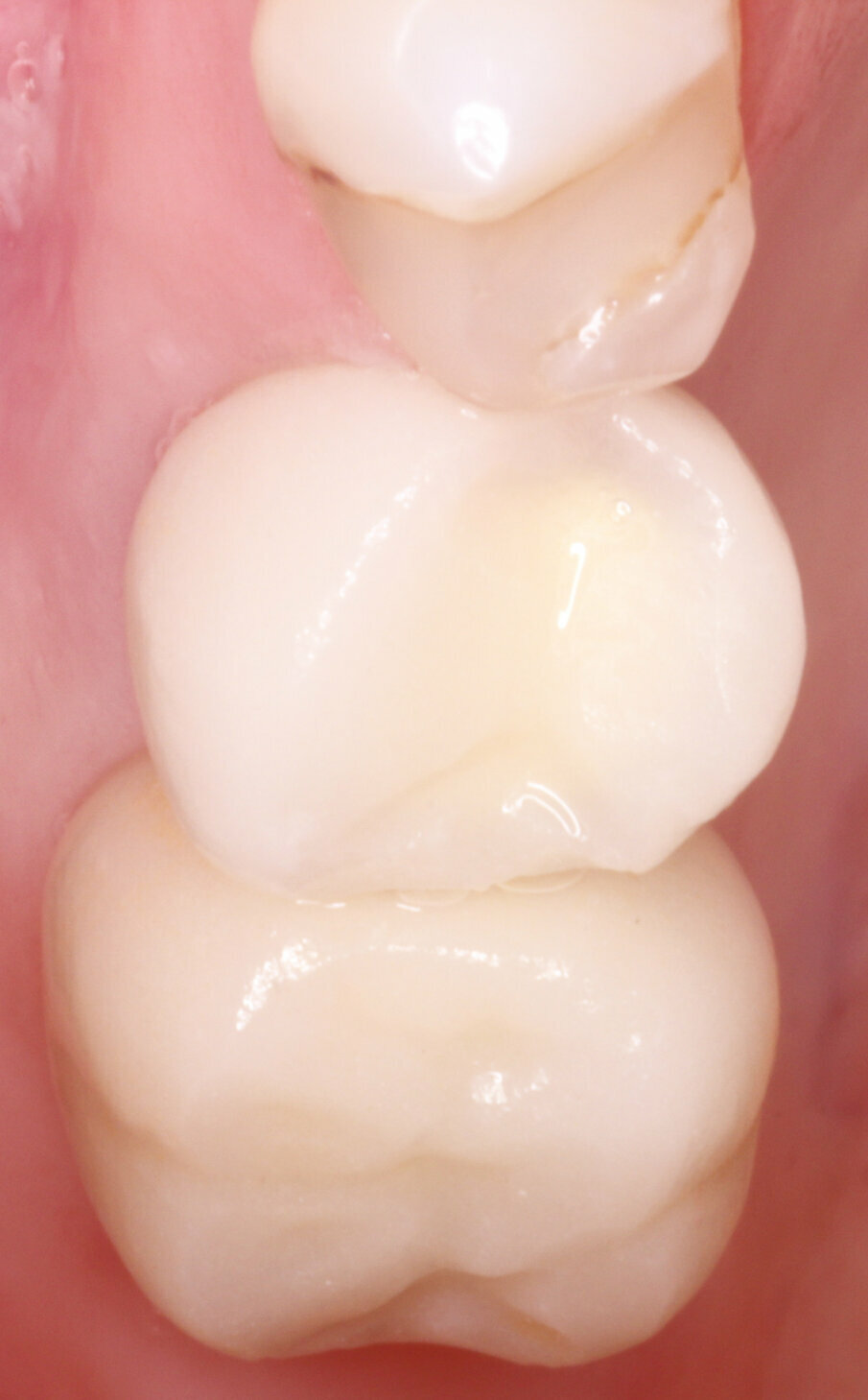 Figs.17: Final zirconia crowns placed