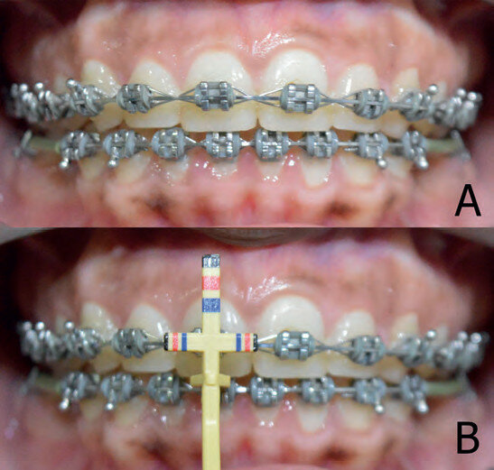 Figs. 2a et b : Inharmonie anatomique entre la longueur des dents antérieures (a). Longueur des dents mesurée au moyen d’une jauge de proportion de Chu (b).