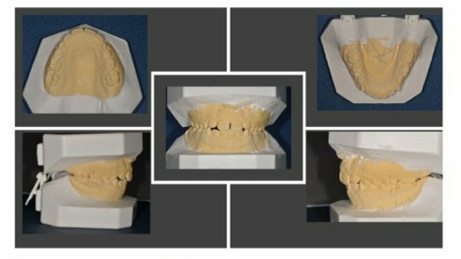Fig. 2_Modello di studio prima del trattamento ortodontico.