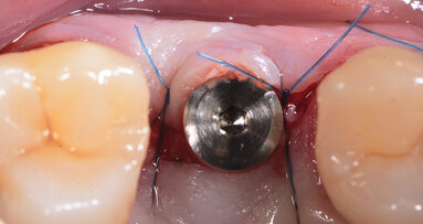 Aspects chirurgicaux d’implants deux pièces en céramique : une solution pour des sites osseux compromis