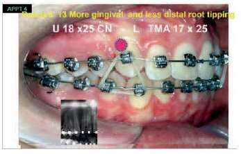 Rebonded 13 in more gingival placement and to correct tipping (see panorex) - Vertical elastics
