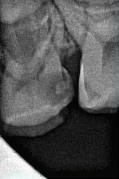 Фиг. 2 Предоперативна рентгенография на зъб #64. (Снимка: д-р Anne Heinz)
