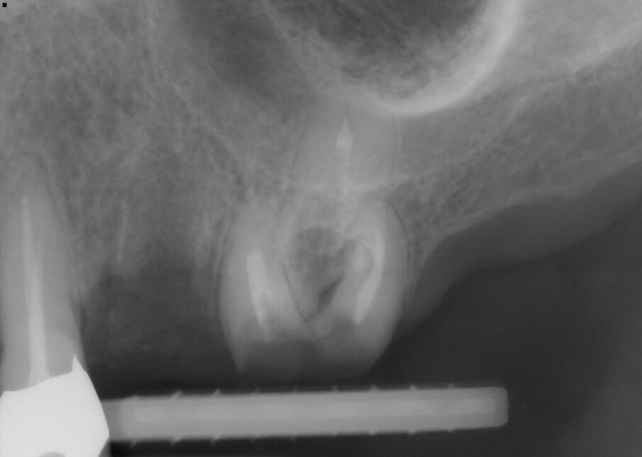 Fig. 1: Tooth #26 presented bent and diverging roots. The tooth was severely decayed. 