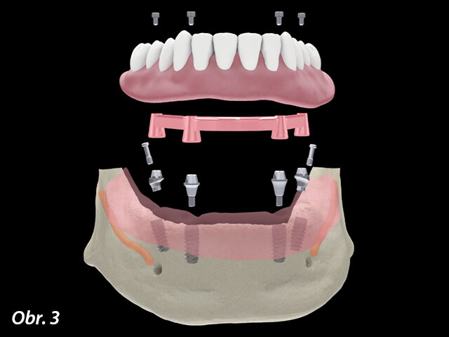 Multi Unit Abutments rovné a angulované (17 °) jsou vynikající pro složité rekonstrukce zubních oblouků, kde jsou disparalelně zavedené implantáty (tzn. rozbíhavé kanály pro šroubky). Lze je využít pro všechny typy náhrad kotvených implantáty.