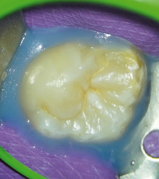 Figs. 7a et b : (a) Les photographies cliniques de la dent juste avant le début du traitement endocanalaire et (b).juste après la préparation du puits d’accès endodontique. 