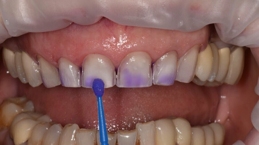 Fig. 11: Cleaning of the dental hard-tissue bonding surfaces in a clinical situation where sandblasting was not recommended owing to the high risk of periodontal soft-tissue bleeding.