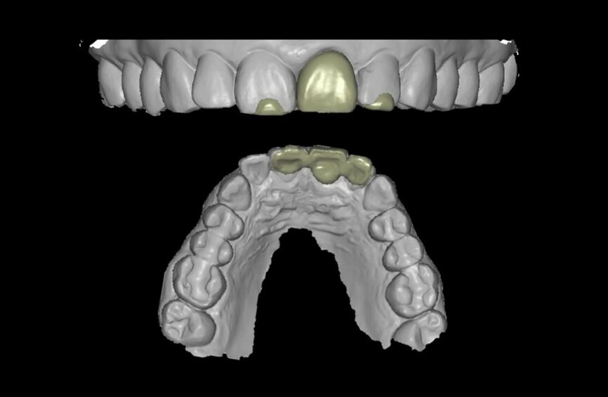 Fig. 20: Temporary crown designed in coDiagnostiX (Dental Wings).