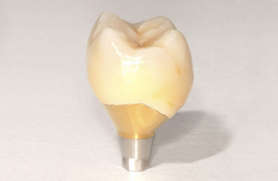 Fig. 13: Definitive implant restoration with the finishing line close
to the gingival margin, allowing for easy removal of excess cement in the subgingival area. The restoration was ready to be delivered to the patient.