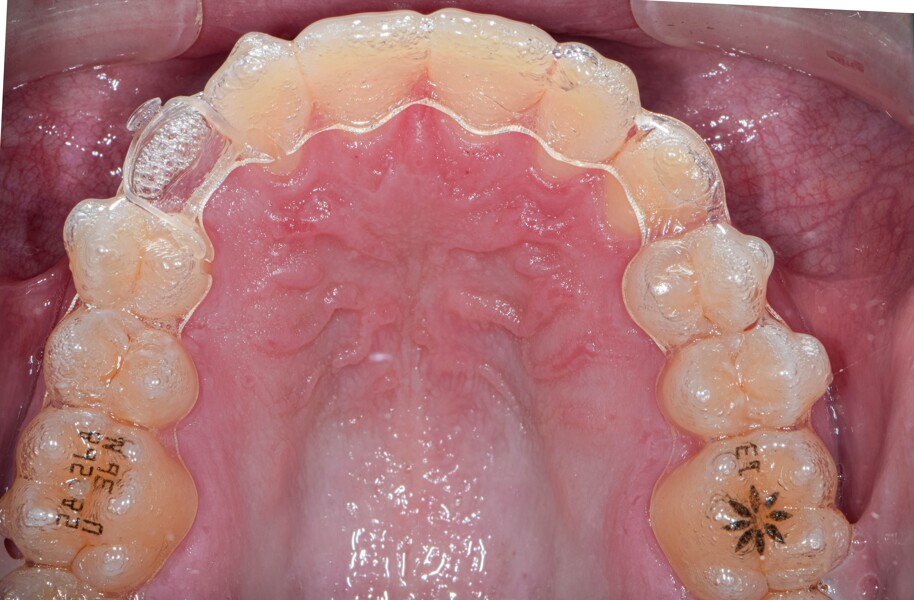 Fig. 6: Progress photographs showing a clear Precision Aligner Button which the surgeon attached to the canine. Notches were placed for the bootstrap elastic on the lingual aspect of the maxillary lateral incisor and first premolar, using the Tear Drop instrument.