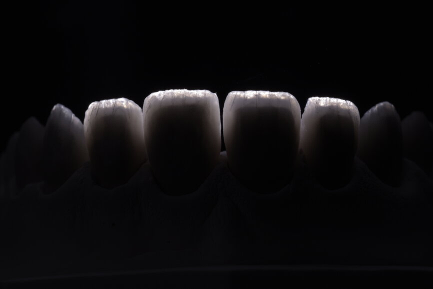 Fig. 72: Incisal edges of units with reflected light to view incisal effects.
