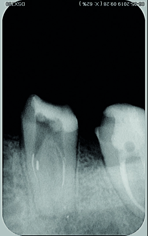 Fig. 5 : Radiographie après retrait de la partie coronaire de gutta-percha et création d’une plate-forme de travail