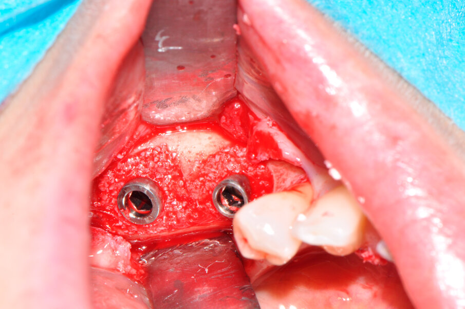 Fig. 6 - I due difetti perimplantari sono innestati col biomateriale a lento riassorbimento.