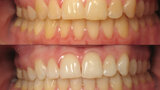 Figura 7. Caso clínico antes y después del blanqueamiento dental en casa con cubetas personalizadas.