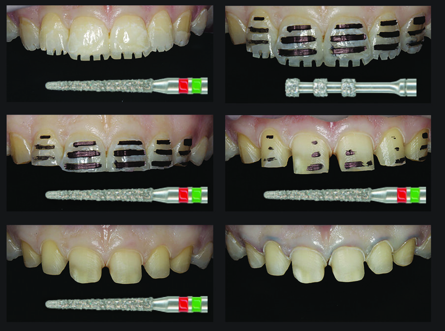Figure 7: The individual minimally invasive preparation steps in the upper anterior teeth