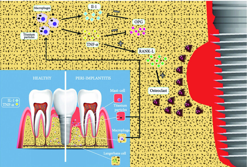 Fig. 1 : Interaction entre les cellules immunitaires et les cytokines dans un site sain et un site touché par la péri-implantite.