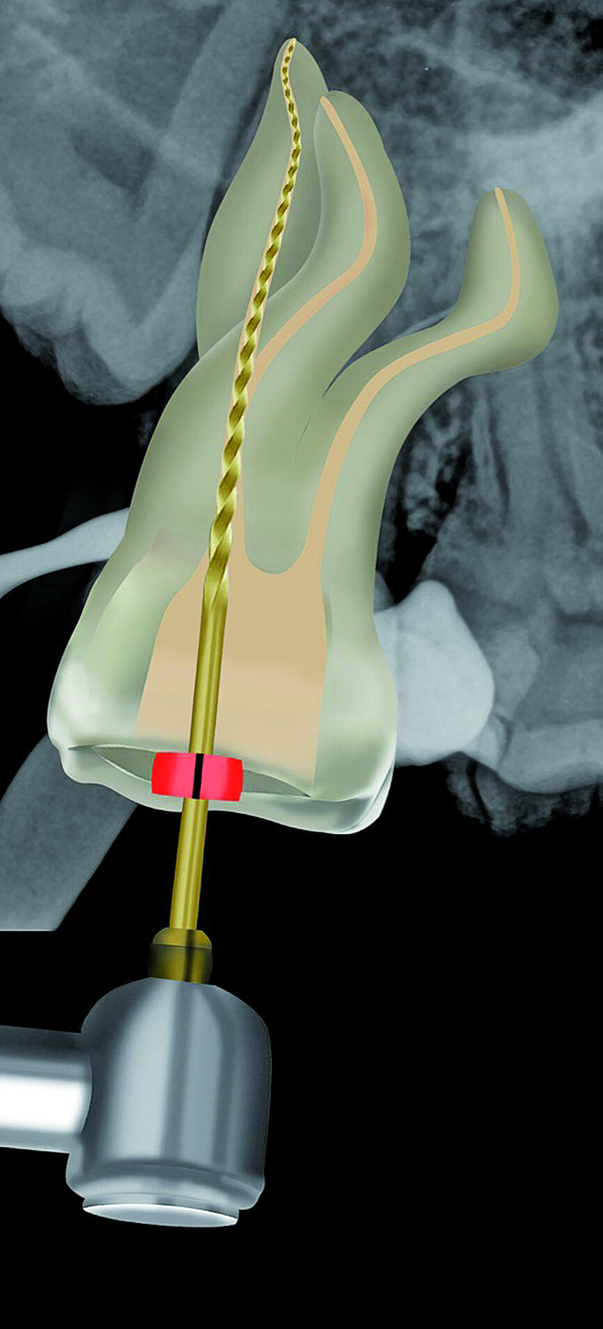 Fig. 26: The Primary WaveOne Gold file (25/07) was used to complete canal preparation in the palatal root canal.