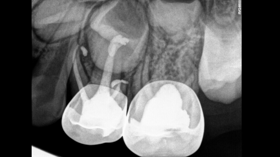 Fig. 21: Obturation of three root canals and final restoration.