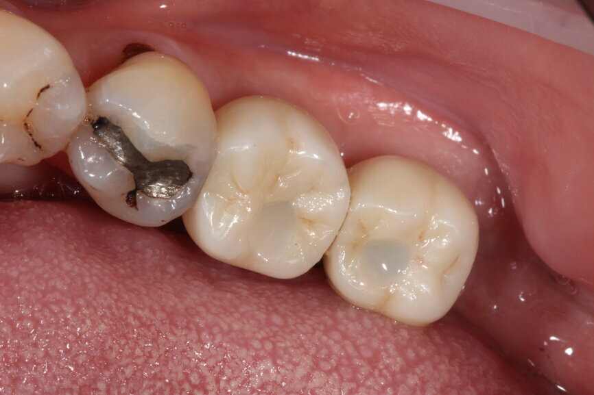 Fig. 13: Implant crowns in situ.