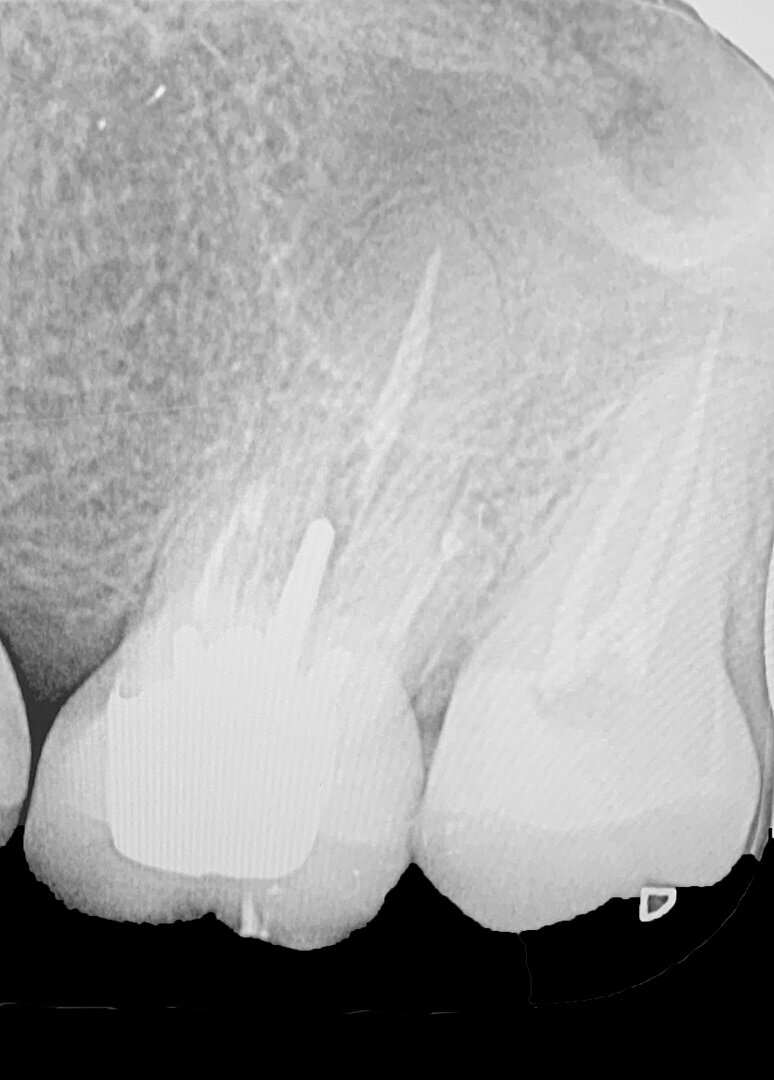 Fig. 3: Radiograph after endodontic treatment.