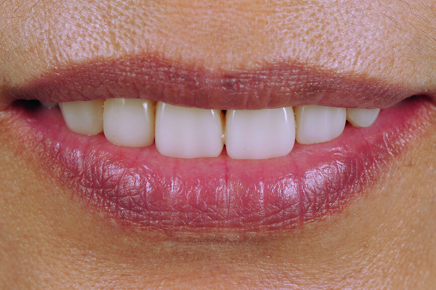 Fig. 26: Four-year follow-up: frontal view of smile.