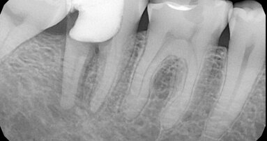 Rešavanje problema neuspelog endodontskog lečenja zuba