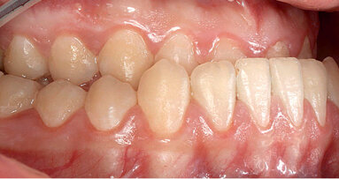 Komplexní ortodonticko-chirurgické ošetření funkčně estetické vady