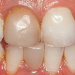 Dinámica lumínica en dientes anteriores con cerámica vítrea