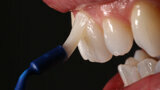 Figura 12. Barniz Profluorid para el tratamiento de hipersensibilidad dental.