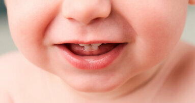 Uno studio sulla dentizione primaria collega l’esposizione alle tossine nei primi anni di vita all’autismo