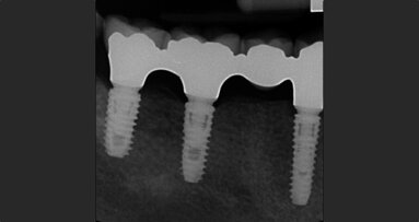 Open-cohort prospective study on early implant failure and physiological marginal remodeling expected using sandblasted and acid-etched bone level implants featuring an 11° Morse taper connection within one year after loading