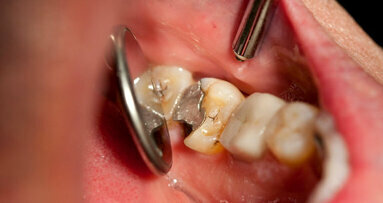 La Commission européenne étudie les aspects environnementaux du mercure dans les amalgames dentaires