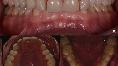 Fig. 1. Fotografías intraorales iniciales, vista frontal (A), vista oclusal del maxilar (B) y vista oclusal de la mandíbula (C).