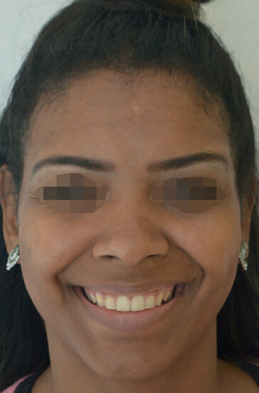 Fig. 5 : La patiente présente un mouvement d’ouverture harmonieux de la lèvre supérieure dix jours après l’injection de toxine botulinique.