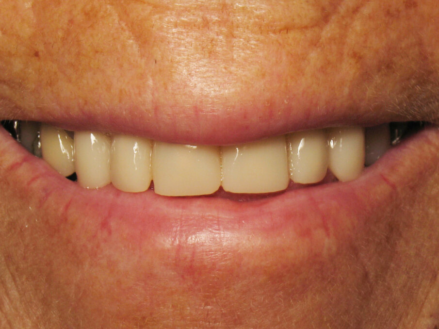 Fig. 9: Smile with provisional crowns.