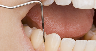 Zahnreport 2017: Parodontitistherapie erfolgt oft zu spät
