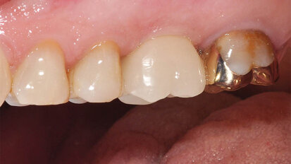An intelligent treatment concept for the implant-supported individual tooth crown