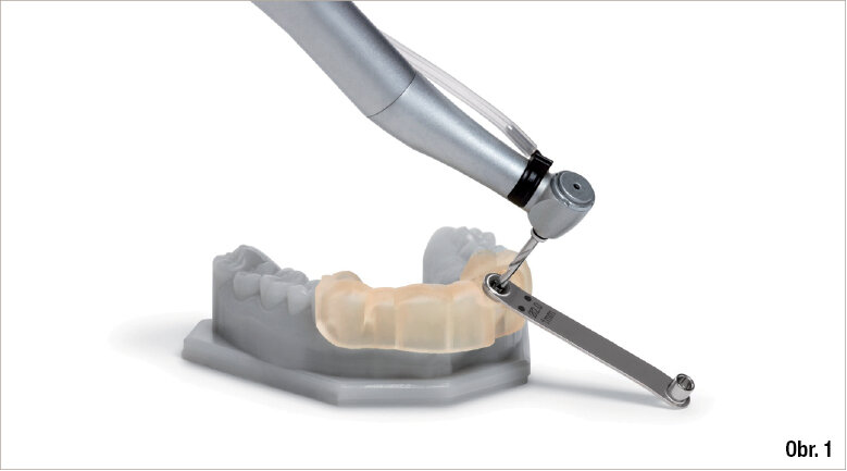 Obr. 1: CAD/CAM chirurgické šablony zcela omezují sklon vrtáku a hloubku preparace a jsou navrženy na základě dat týkajících se konkrétního pacienta z CBCT skenu a z intraorální kamery zpracovaných softwarem pro plánování implantátů