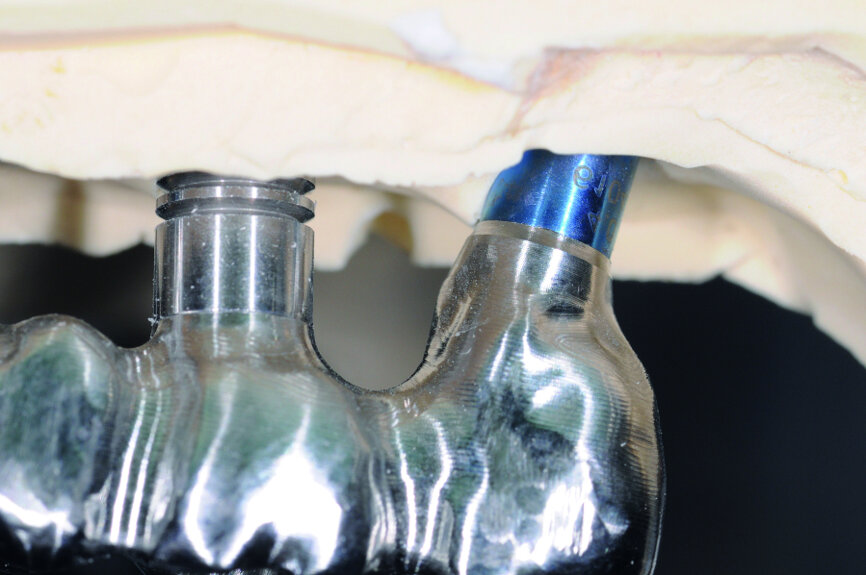 Figure 3 : Détail de la précision obtenue au niveau du joint de l’armature chrome-cobalt, et de l’émergence implantaire fait par CFAO.
