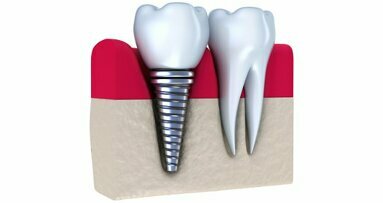 Le temps de cicatrisation des implants dentaires pourrait être réduit
