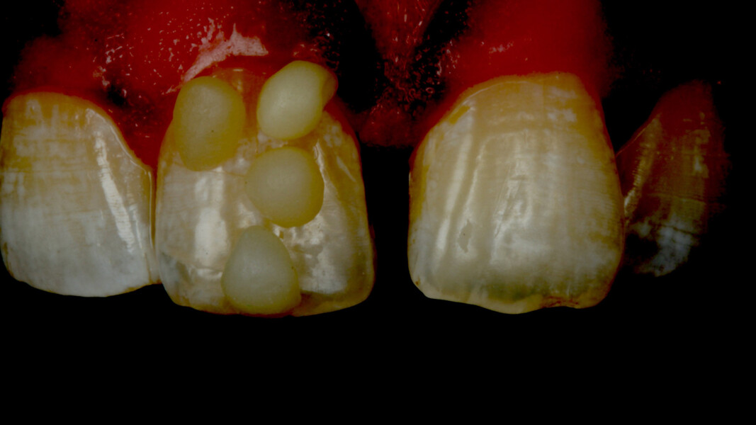 Fig 4. Increasing the contrast and reducing the brightness of a photograph helps evaluate the internal characteristics. There were hypoplastic lines for example, in this case.