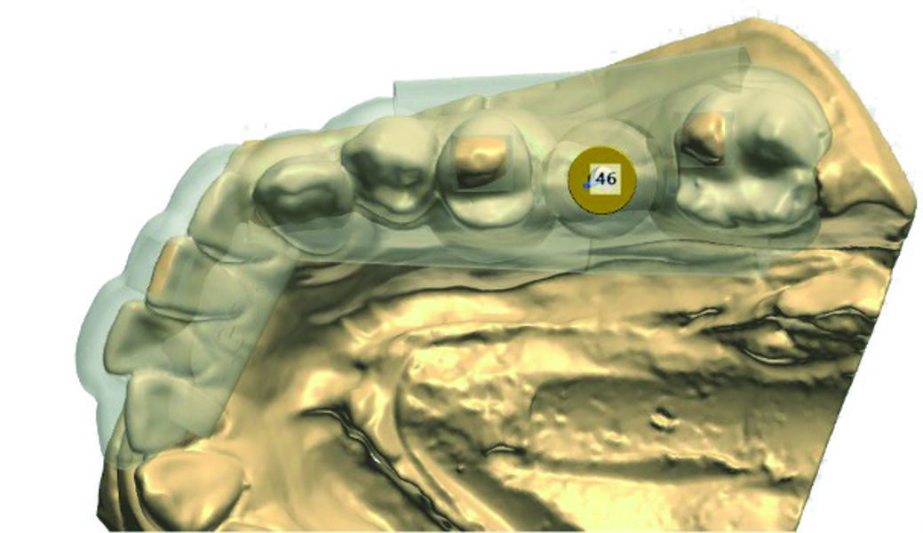Fig. 7 : Choix et prévisualisation du positionnement de la douille MIS correspondant à l’implant choisi, en occlusale.