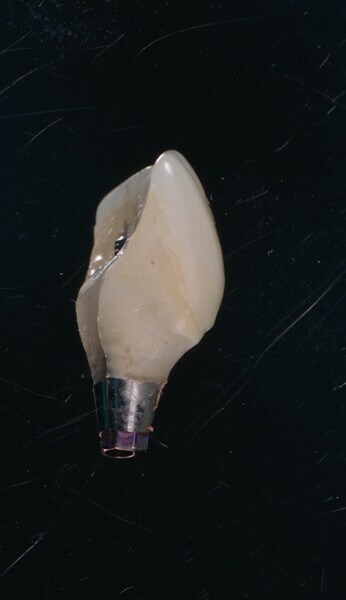 Fig. 14b : Un pilier provisoire (b) est fabriqué au moyen de la coquille reproduisant la face vestibulaire de la dent extraite (a). 