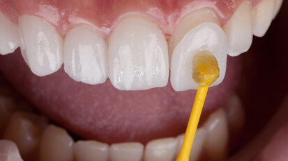 مستقبل قشرة الأسنان التجميلية: تقنية الطباعة الثلاثية الأبعاد