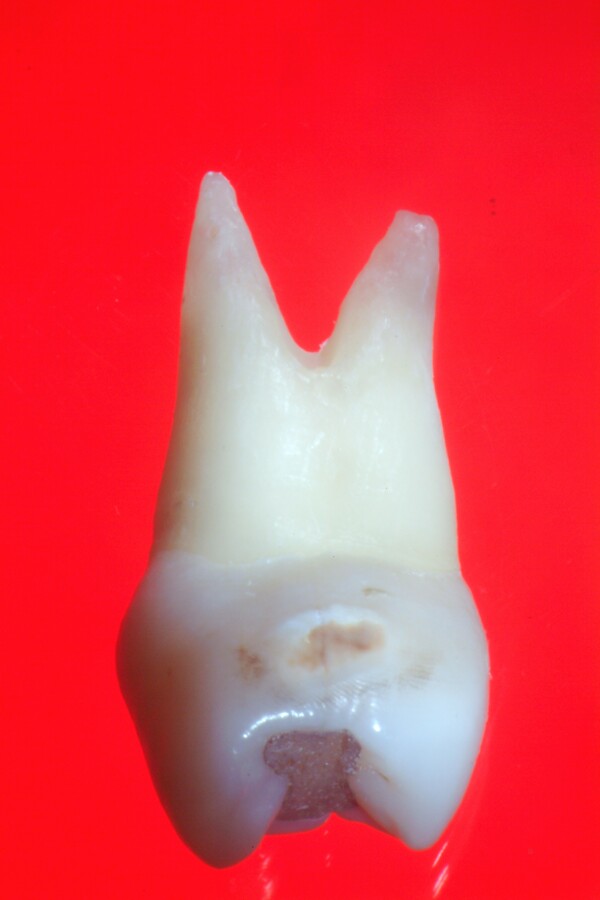 Buccal root of the bifurcated maxillary premolar—a danger zone during