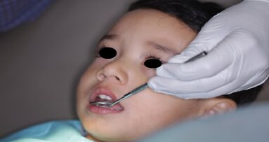 Fluoride varnish application aids in prevention and progression of caries in children