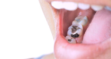 European Parliament bans dental amalgam