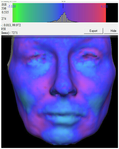 Fig. 4: Morphometric evaluation of the final results: finite element analysis showed increased facial volume with a directional change of almost 4 mm, indicated by the red to orange colour.