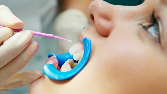 Confirman la eficacia de los selladores dentales en la caries infantil