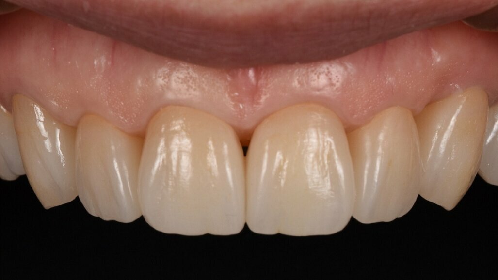 One step closer to nature: Occlusal concepts and sophisticated aesthetics in digital dentistry